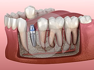 Premolar tooth crown installation over implant abutment. Medically accurate 3D illustration of human teeth and dentures
