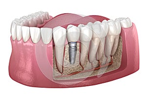 Premolar tooth crown installation over implant abutment. Medically accurate 3D illustration of human teeth and dentures concept photo