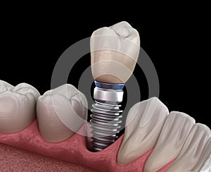 Premolar tooth recovery with implant. Medically accurate 3D illustration of human teeth and dentures