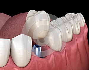 Premolar tooth recovery with implant. Medically accurate 3D illustration of human teeth and dentures