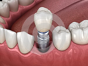 Premolar tooth recovery with implant. Medically accurate 3D illustration of human teeth and dentures