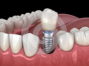 Premolar tooth recovery with implant. Medically accurate 3D illustration of human teeth and dentures concept