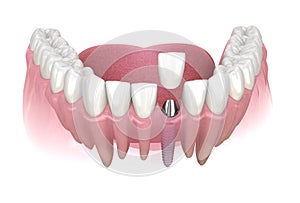 Premolar tooth recovery with implant. Medically accurate 3D illustration of human teeth and dentures concept