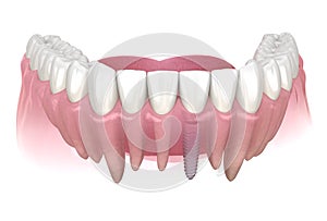 Premolar tooth recovery with implant. Medically accurate 3D illustration of human teeth and dentures concept