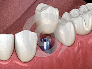 Premolar tooth recovery with implant. Medically accurate 3D illustration of human teeth and dentures photo