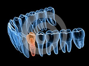 Premolar tooth recovery with implant, x-ray view. Medically accurate 3D illustration of human teeth and dentures