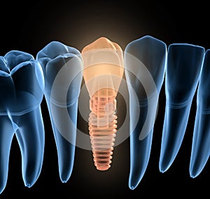 Premolar tooth recovery with implant, x-ray view. Medically accurate 3D illustration of human teeth and dentures photo