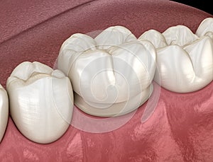 Preparated molar tooth for dental crown placement. Medically accurate 3D illustration