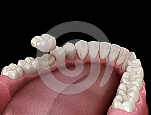 Preparated molar tooth for dental crown placement. Medically accurate 3D illustration