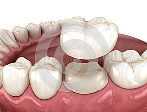 Sedia dente dentale corona posizione. dal punto di vista medico accurato illustrazioni 