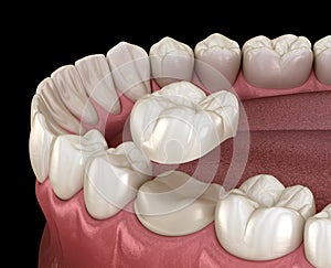 Preparated molar tooth for dental crown placement. Medically accurate illustration
