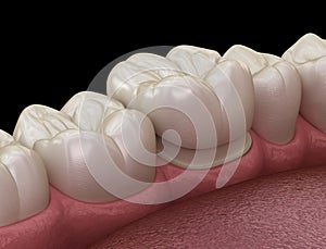 Preparated molar tooth for dental crown placement. Medically accurate illustration