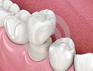 Preparated premolar tooth and dental crown placement. Medically accurate 3D illustration