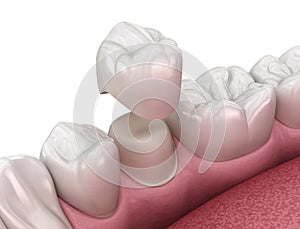 Preparated premolar tooth and dental crown placement. Medically accurate 3D illustration