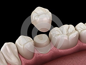 Preparated premolar tooth for dental crown placement. Medically accurate illustration