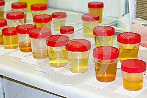 Preparation of urine samples in the laboratory in the hospital for the study. Special test strips for urine examination photo