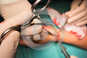 Prepare radial artery for arteriovenous fistula