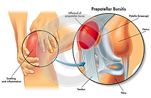 Prepatellar bursitis illustration