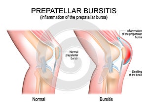 Prepatellar bursitis. inflammation of the prepatellar bursa