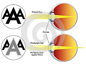 Presbyopia