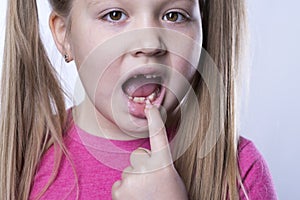 A preschool girl with her first adult incisors. The milk tooth has fallen out, and a permanent tooth grows in the open