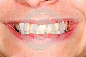 Pressed ceramic teeth