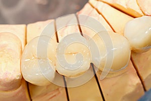 Pressed ceramic teeth