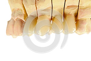 Pressed ceramic teeth