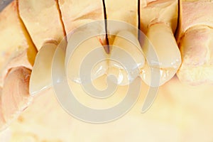 Pressed ceramic teeth