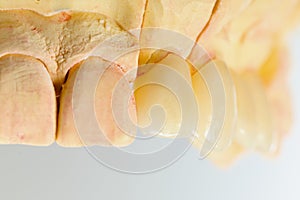 Pressed ceramic teeth