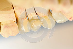 Pressed ceramic teeth