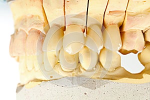 Pressed ceramic teeth