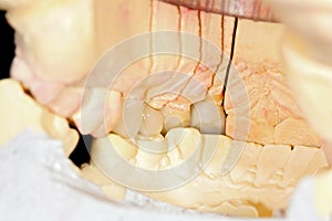 Pressed ceramic teeth