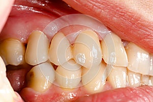 Pressed ceramic teeth in oral cavity photo