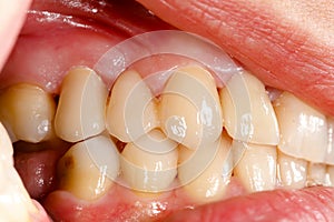 Pressed ceramic teeth in oral cavity
