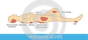 Pressure sores area photo