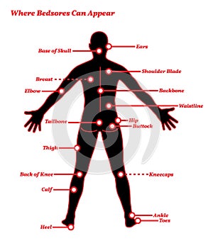 Pressure Sores Bedsores Ulcers Human Anatomy Illustration