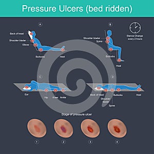 Pressure Ulcers bed ridden.