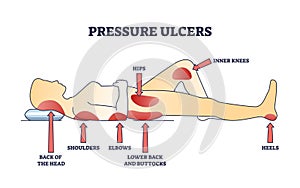 Pressure ulcers or bedsores skin tissue injuries locations outline diagram photo