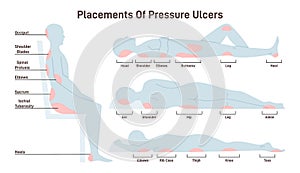 Pressure ulcers placements. Pressure sores areas on human body part photo