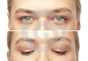A pretty girl model poses after a cosmetic skin rejuvenation procedure. Closed and open eyes close up.