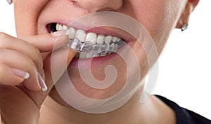 Preventive teeth braces photo