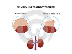 Primary aldosteronism causes: adrenal tumor and hyperplasia