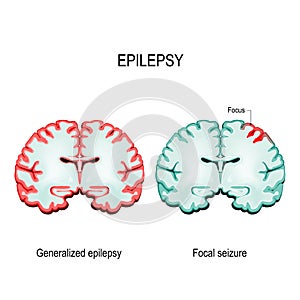 Primary generalized epilepsy and focal seizures photo
