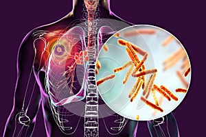 Primary lung tuberculosis, 3D illustration photo