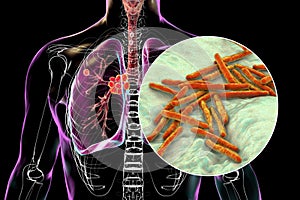 Primary lung tuberculosis, 3D illustration photo