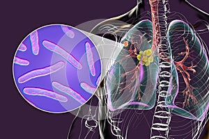 Primary lung tuberculosis, 3D illustration