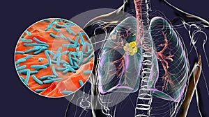 Primary lung tuberculosis, 3D illustration