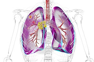 Primary lung tuberculosis, illustration