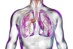 Primary lung tuberculosis, illustration